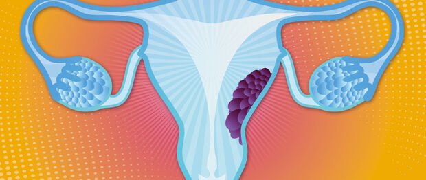 Graphik Endometriumkarzinom – Gebärmutterkrebs