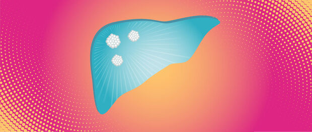 Graphik Hepatozelluläres Karzinom – Leberzellkrebs